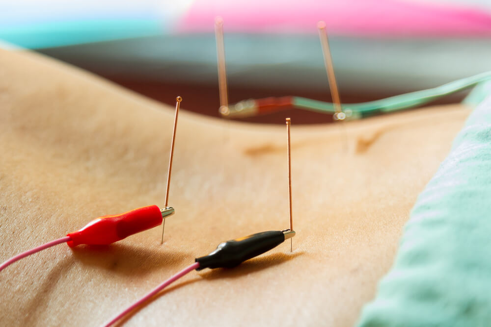 E-Stim II® Electro Acupuncture Device